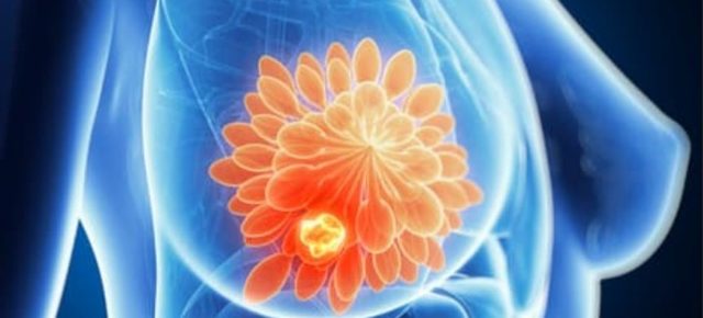 Sistemul de inteligență artificială B-RAD îmbunătățește acuratețea ecografiilor mamare și reduce erorile de diagnostic